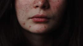 Ilustrasi wajah berjerawat. (Foto: Pelopor/Unsplash)