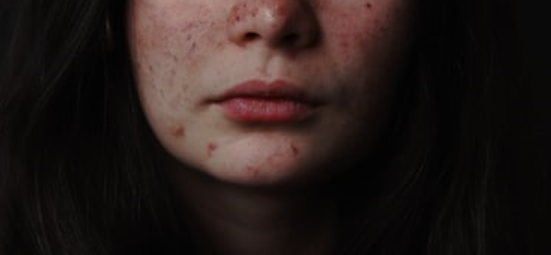 Ilustrasi wajah berjerawat. (Foto: Pelopor/Unsplash)