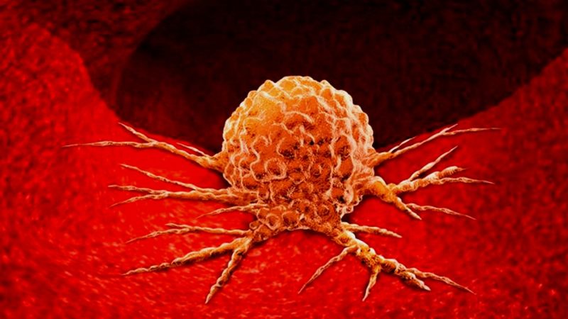 Ilustrasi tumor. (Foto: istimewa)